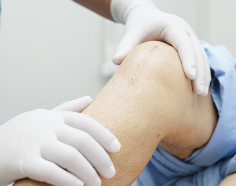 Fisioterapia después de una cirugía